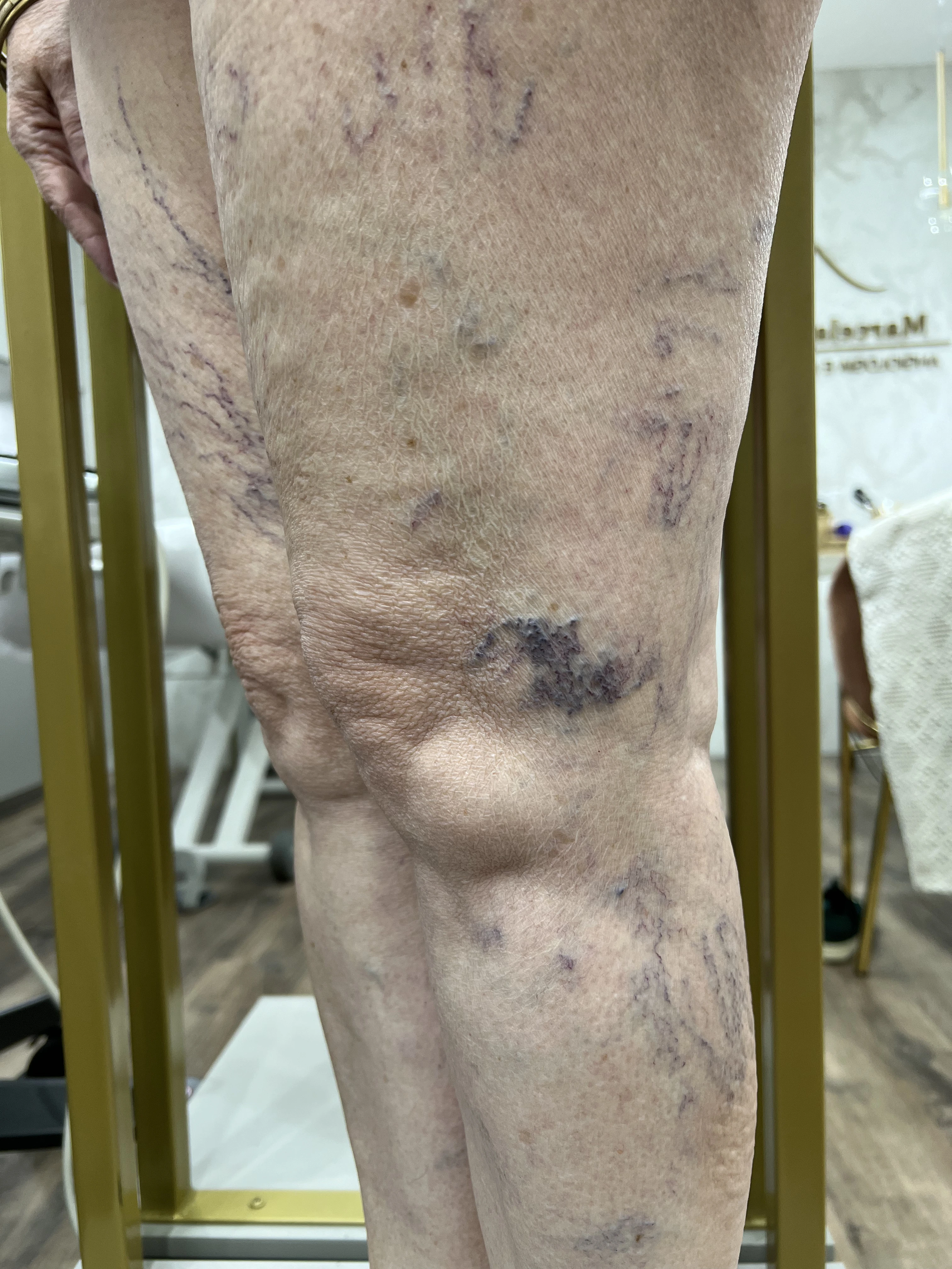 Pernas com varizes antes do tratamento Espuma e Laser Transdérmico